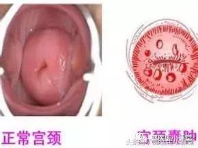 子宫颈多发纳氏囊肿是怎么引起的,宫颈多发纳氏囊肿会不会影响怀孕