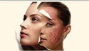 脸上痘痘怎么快速有效消炎,脸上长痘痘了教你一招快速祛痘