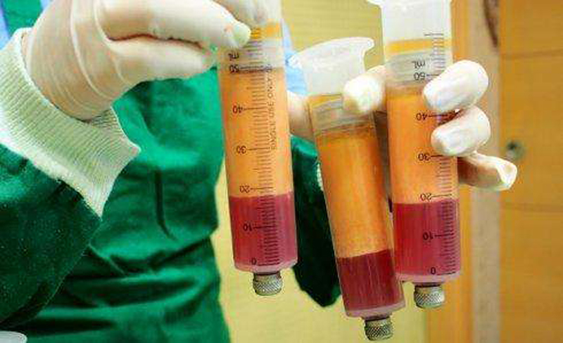 吸脂减肥大概费用是多少呢,吸脂减肥20斤该花费多少钱呢