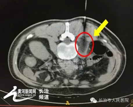 冷冻消融治疗肿瘤挂什么科,肿瘤氩氦刀冷冻治疗