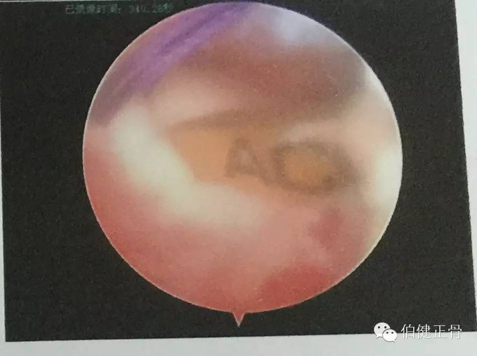 关节内外、经骨骺/不经骨骺单隧道纽扣技术治疗小儿前交叉韧带止点撕脱骨折经验介绍