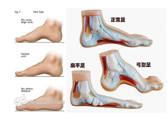 如何让扁平足拥有足弓,扁平足跑起来有足弓