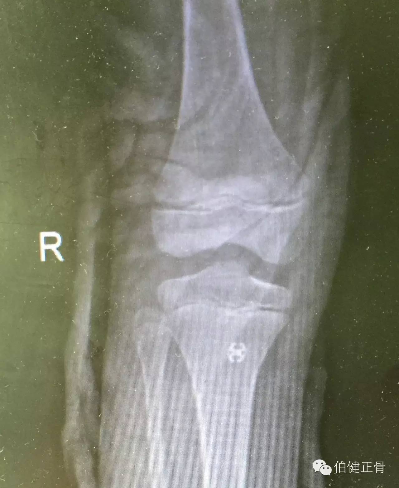 关节内外、经骨骺/不经骨骺单隧道纽扣技术治疗小儿前交叉韧带止点撕脱骨折经验介绍