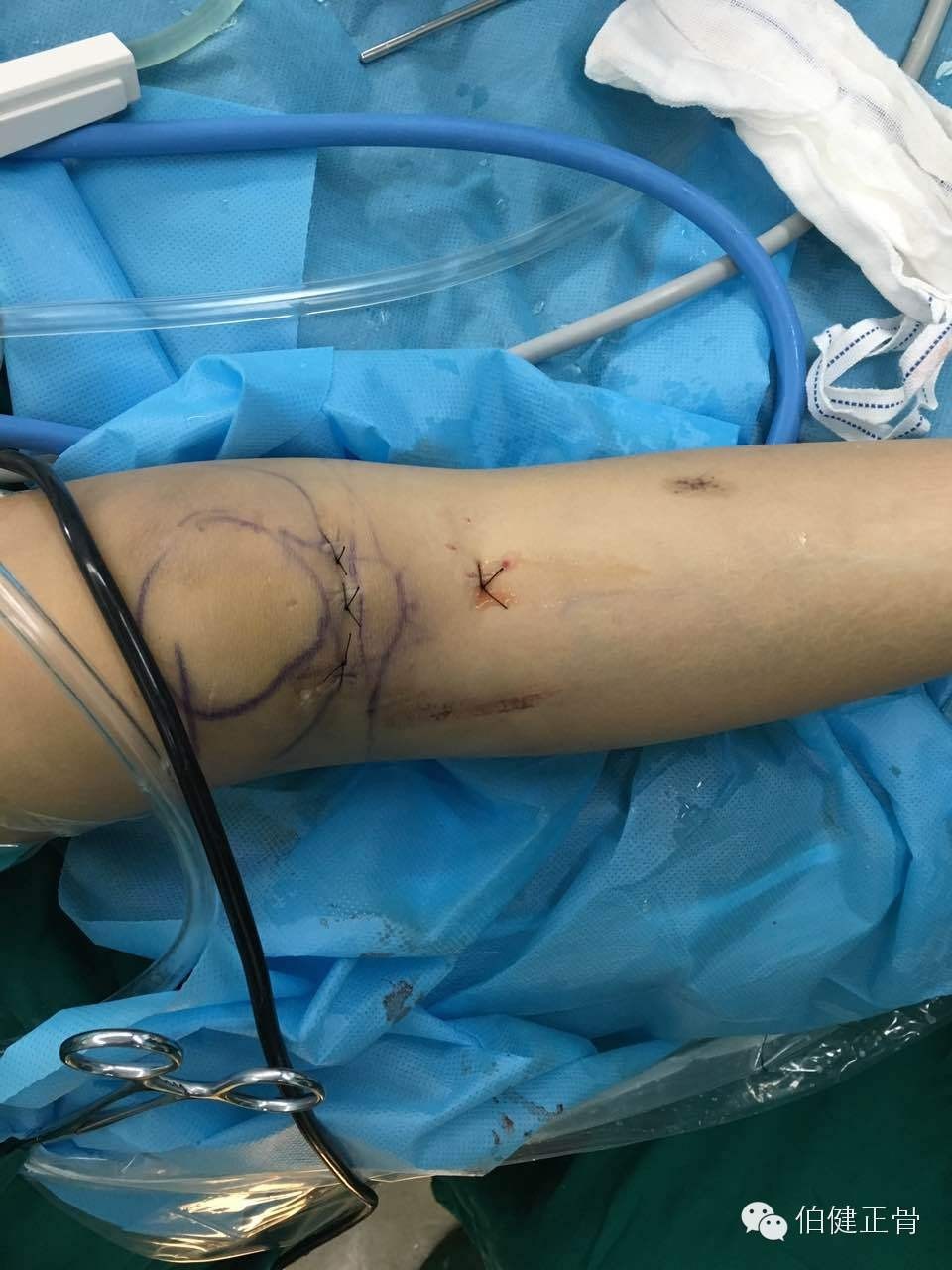 关节内外、经骨骺/不经骨骺单隧道纽扣技术治疗小儿前交叉韧带止点撕脱骨折经验介绍