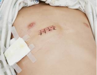 先心病可以做微创手术吗,先心病开胸和微创哪个治愈率高