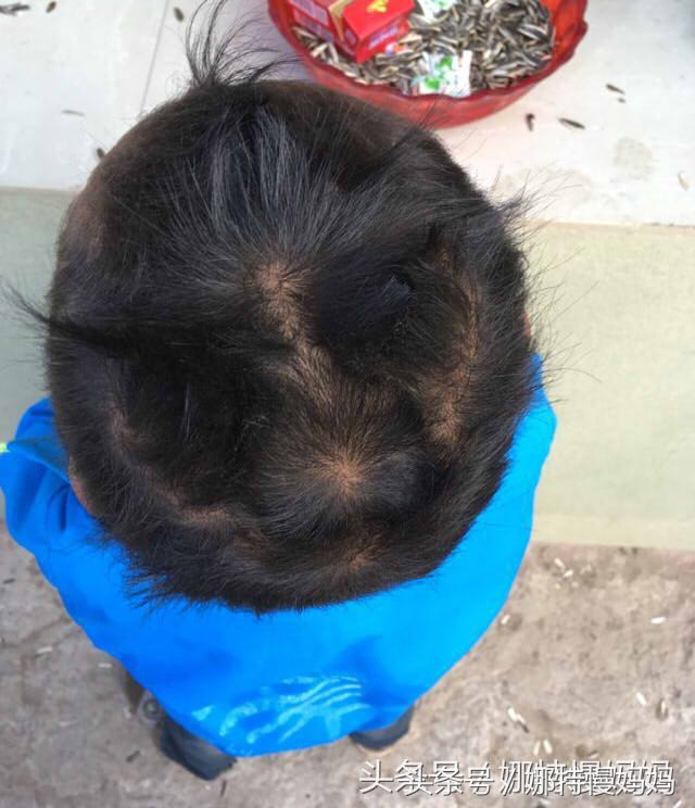 宝宝的头旋有什么说法吗,宝宝的头旋为啥是歪的