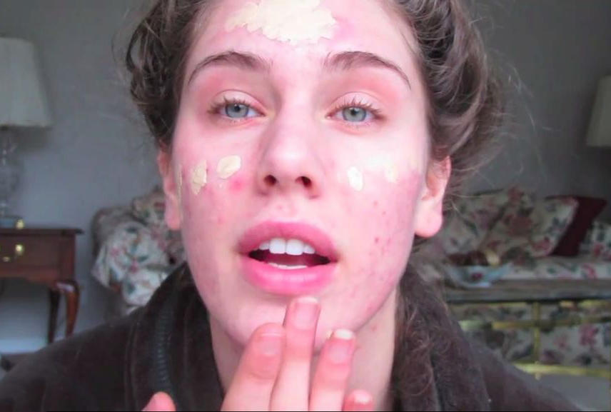 额头反复长痘的原因及解决方法,额头长痘的原因和解决方法