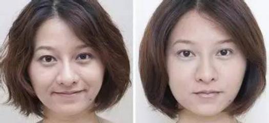 三十岁有法令纹可以做超声刀吗,做完脸部超声刀法令纹变明显了