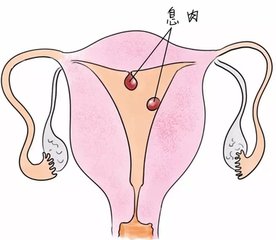 手术后复查发现肿物并没切除,子宫内膜息肉手术后b超复查