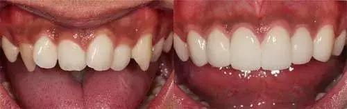 一周快速脸部美白小妙招,美容冠的形态怎么做的