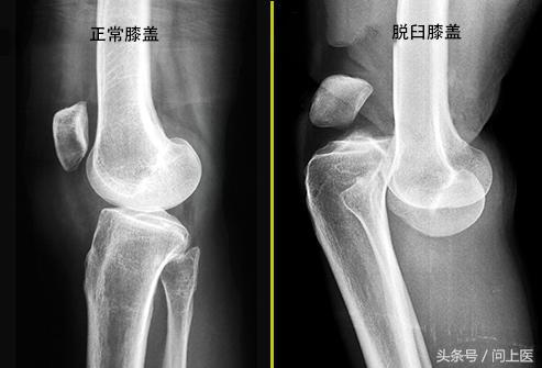 老年人膝盖疼痛的原因和解决方法,上楼梯膝盖疼痛的原因和解决方法
