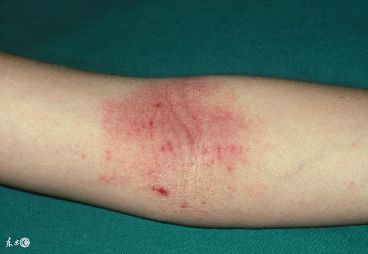 宝宝身上长湿疹可以用什么泡澡,宝宝湿疹饮食注意事项和禁忌