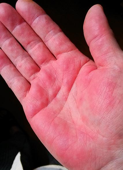 中美肿瘤治愈率,中美联手攻克乙肝能实现吗