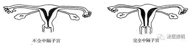 三胞胎在一个子宫吗,三胎双胞胎单角子宫