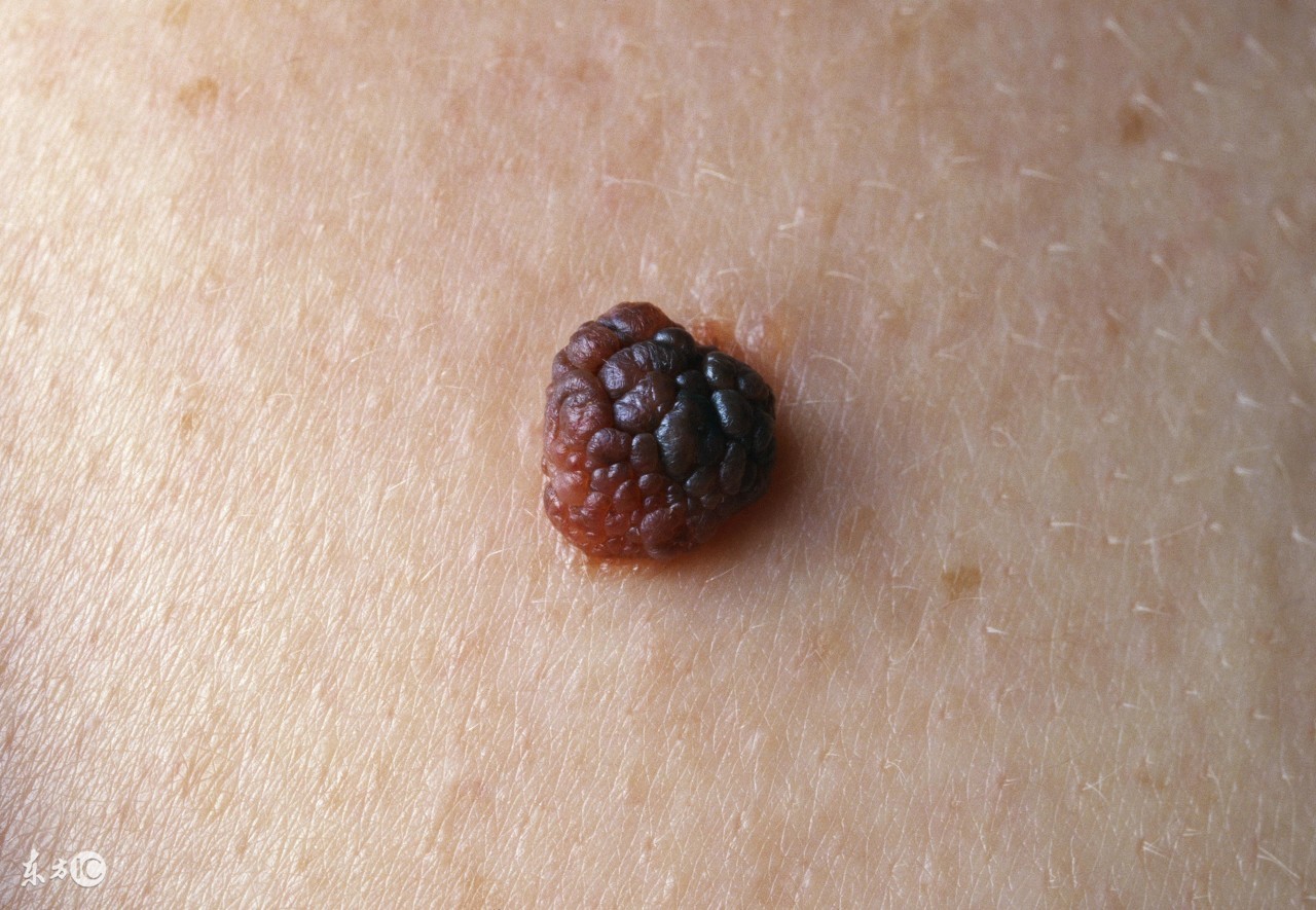 痣破了会感染旁边皮肤吗,表皮痣会癌变吗