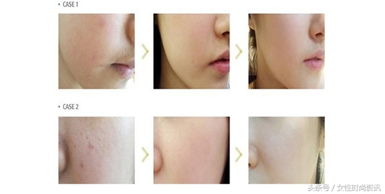 diy针,diy水光针注射