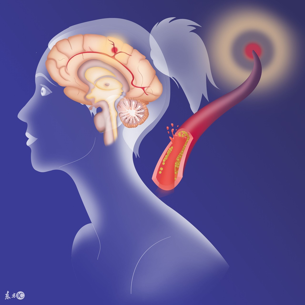 准介入治疗脑卒中及后遗症,脑卒中血管介入治疗