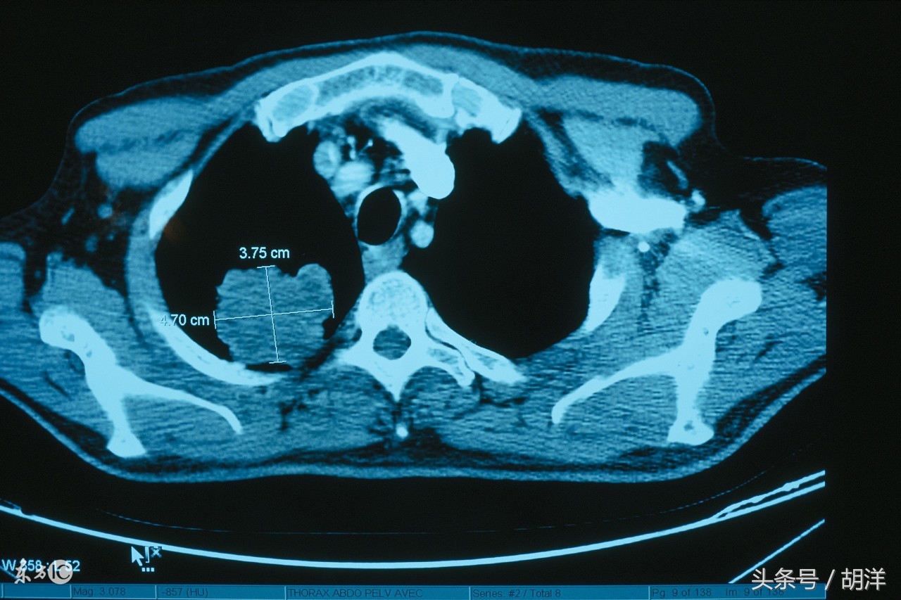 肺癌转移到骨头的病人后期会怎样,肺癌会影响面部神经吗