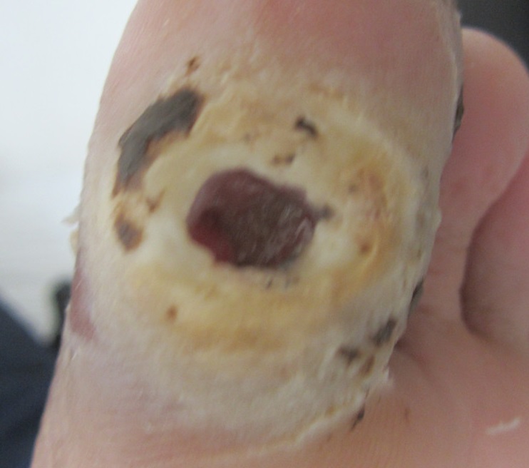 伤口旁边有一圈白色的是什么,伤口上面有白色的一层是什么