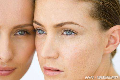 脸上有老人斑怎么去掉,脸上的斑怎么才能去掉呢