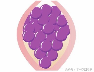 什么是葡萄胎有哪些症状,什么是葡萄胎和双胎