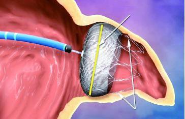 房颤患者是保守治疗还是积极治疗,房颤最主要的治疗是控制心率吗