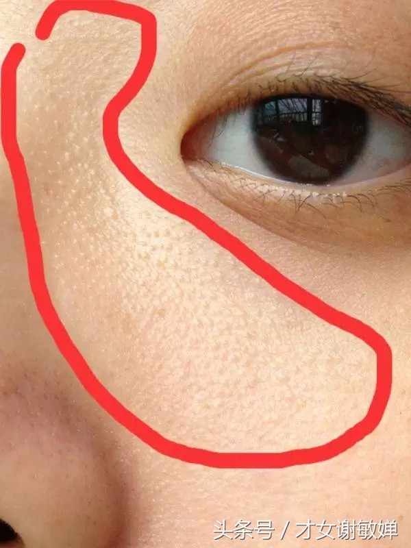 护肤处理闭合粉刺,谢敏婵的护肤品