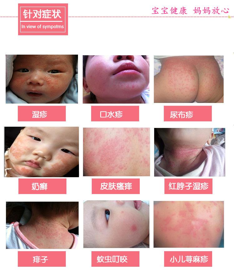 三个月大宝宝湿疹严重怎么护理,新生儿湿疹怎么护理最有效