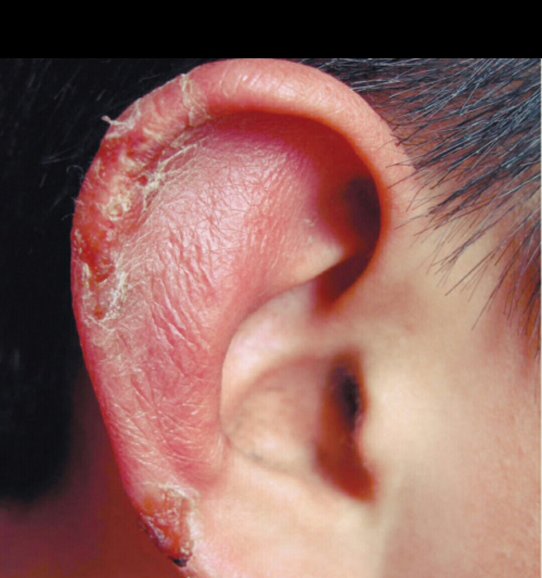 冻伤疮什么意思,手冻伤起疮最有效的方法