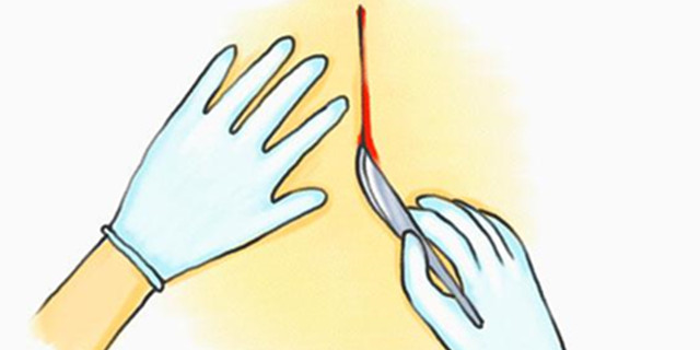 什么是侧切的演示,什么是侧切生孩子