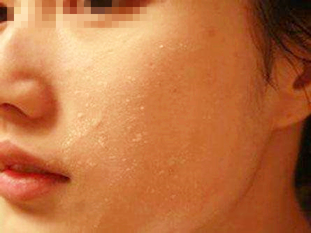 宝宝手上长倒刺脱皮缺什么,宝宝手起疹子皲裂