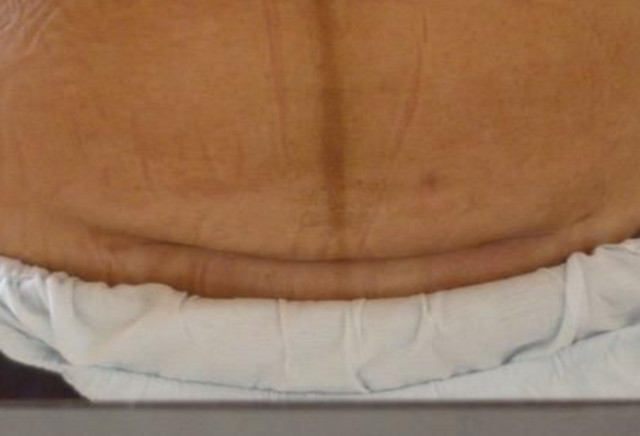 女人剖腹产两年疤痕痒痒,剖腹产刀口发痒能喝醪糟吗