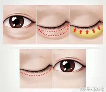 无痕去眼袋案例分享,微创无痕去眼袋