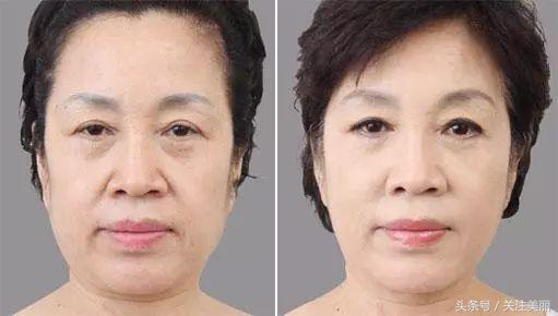 打完瘦脸针多久可以吃阿莫西林,打完除皱瘦脸针多久能洗脸敷面膜