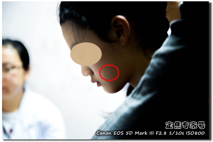 头皮癣治疗要多少钱,治疗头皮型银屑病需要多少钱