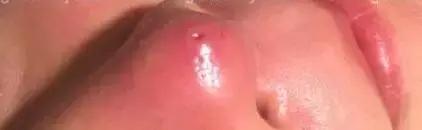 假体隆鼻都有什么术式,假体隆鼻一般用什么材料