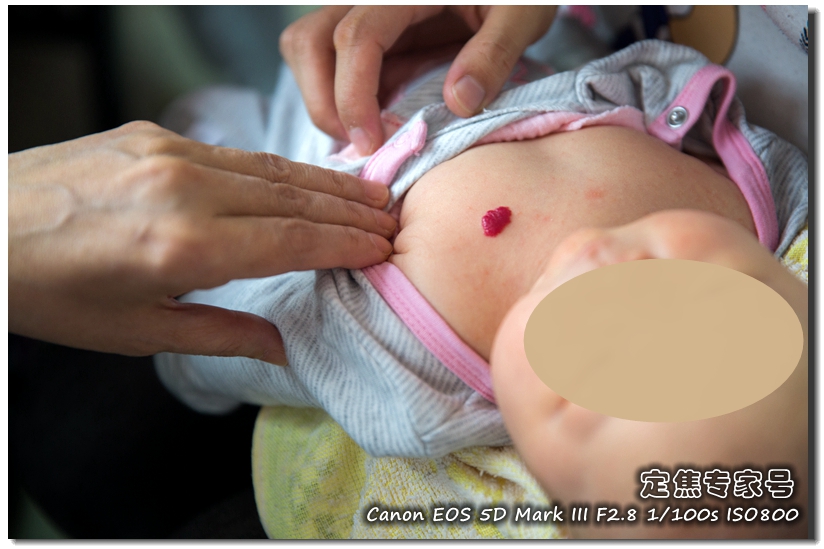 头皮一块一块的红斑,头皮癣治疗要多少钱