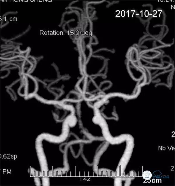 天坛医院脑血管狭窄手术做得好吗,天坛医院动脉狭窄介入手术费用