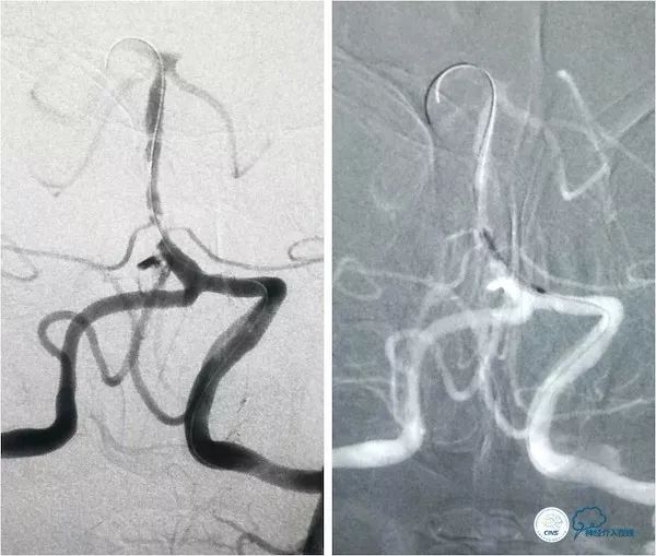 天坛医院脑血管狭窄手术做得好吗,天坛医院动脉狭窄介入手术费用