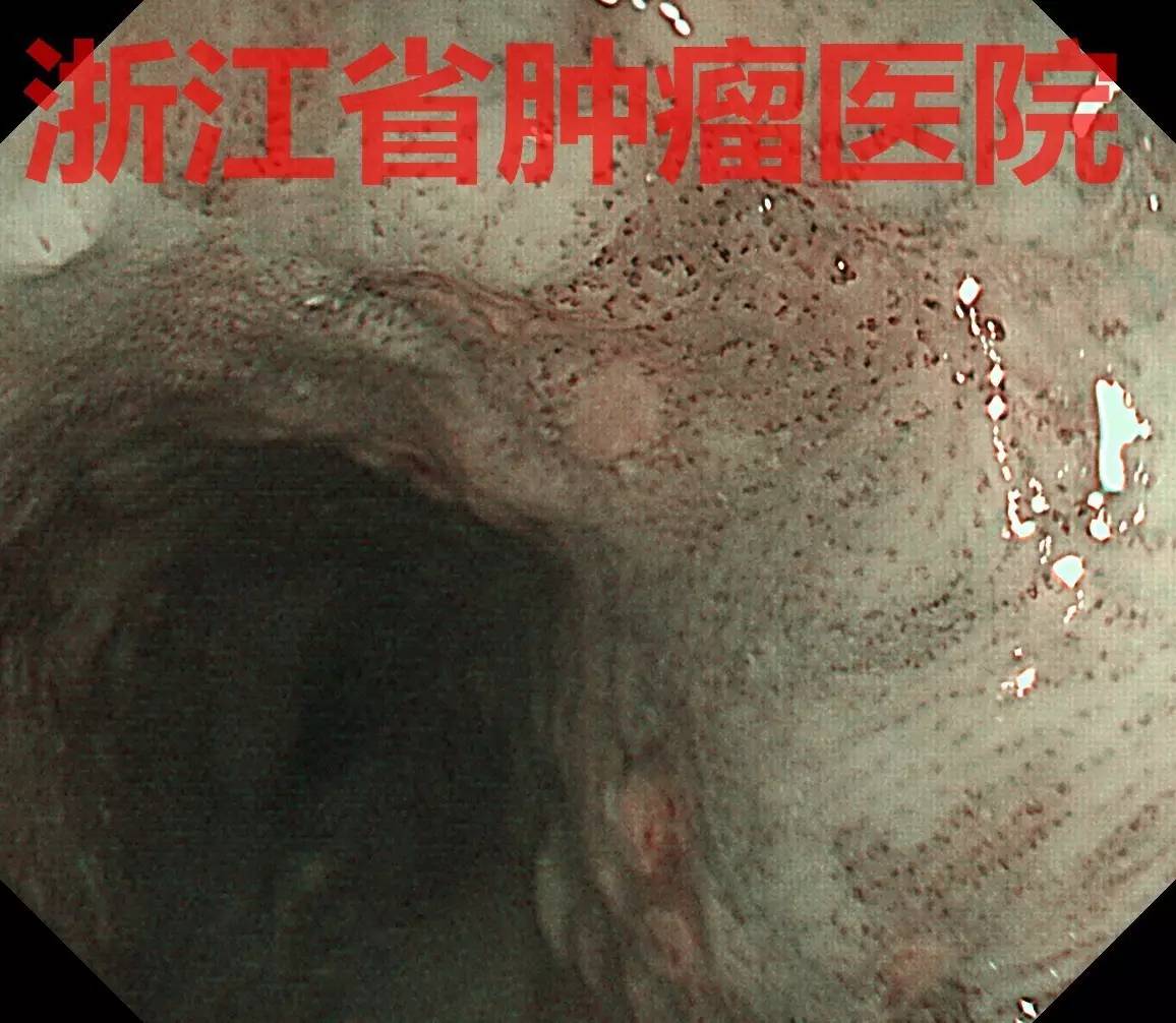 食管黏膜病变越大就一定是恶性吗,食管病变严重需要怎么治疗