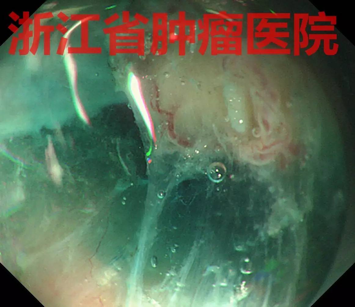 食管大面积黏膜病变，看看这家医院如何处理？！