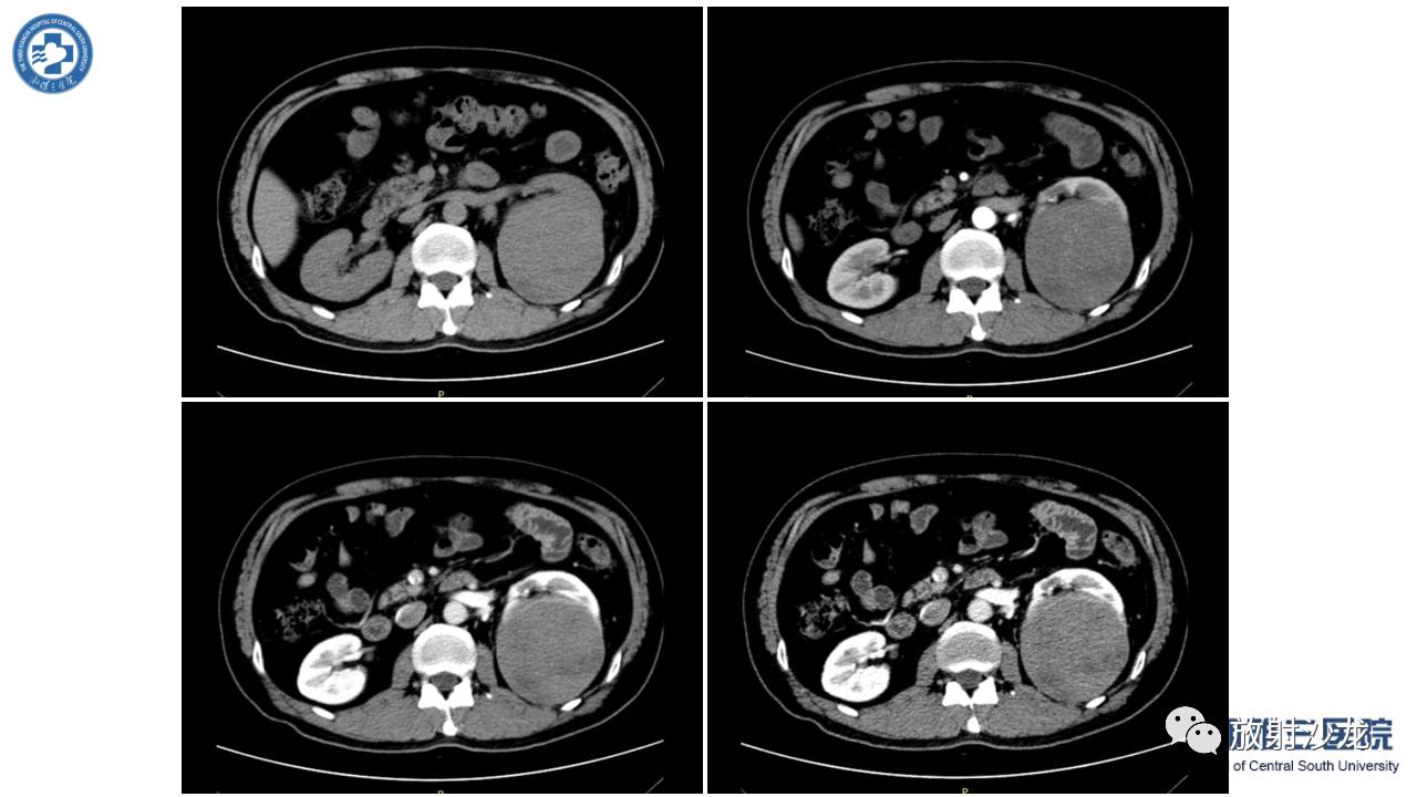 「每日一例｜489例」男，左侧腰部撞伤后疼痛3月