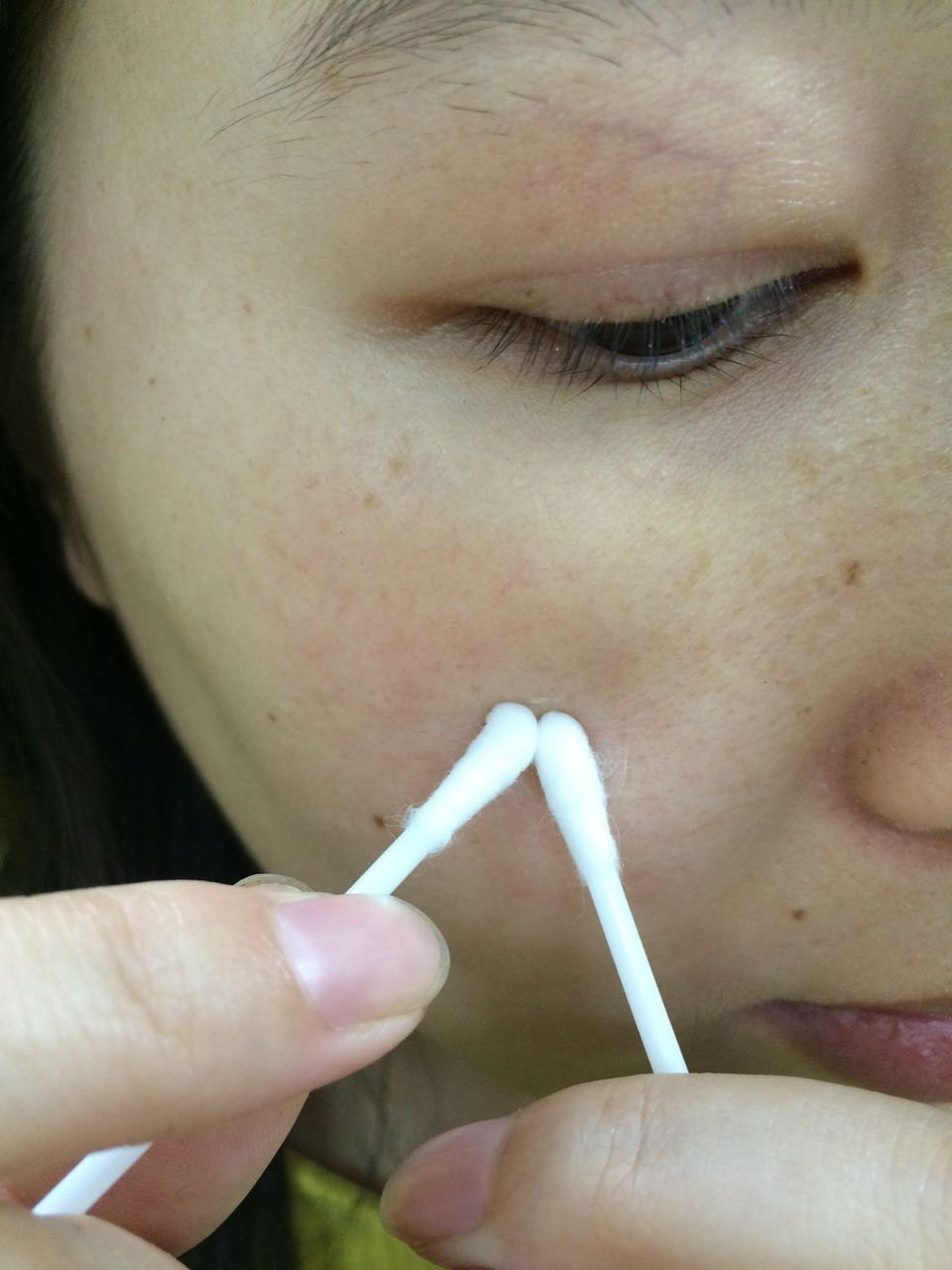 健康关注重点,哪些位置的痘不能随便乱挤