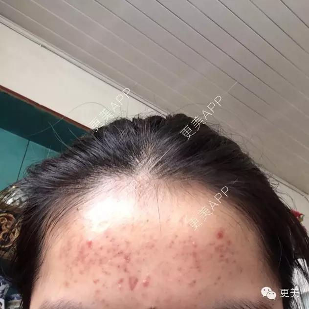 长痘痘泛红皮肤怎么护肤,长痘痘红的怎么马上消