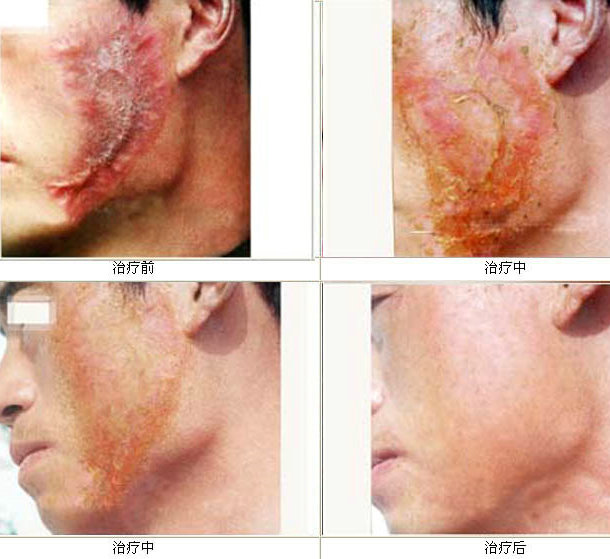 伤口怎样不留疤痕最好的方法,皮肤伤口怎么不留疤痕