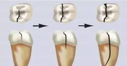 牙齿有矿物质怎么处理,牙齿有洞用什么充填