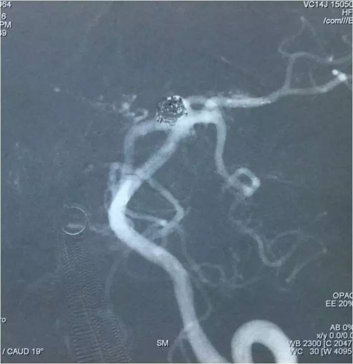 基底动脉顶端动脉瘤加左侧小脑上动脉瘤以Y型支架结合弹簧圈栓塞