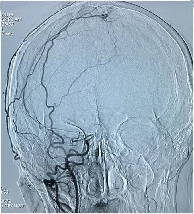 基底动脉顶端动脉瘤加左侧小脑上动脉瘤以Y型支架结合弹簧圈栓塞