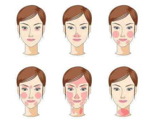 怎么去脸部*血丝红**-敏感肌修复瑞玲老师8000肤诊案例连载009