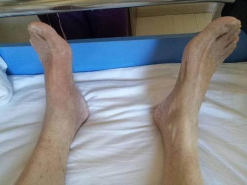 老年腿肿血栓用做手术吗,老人腿部血栓不治的后果